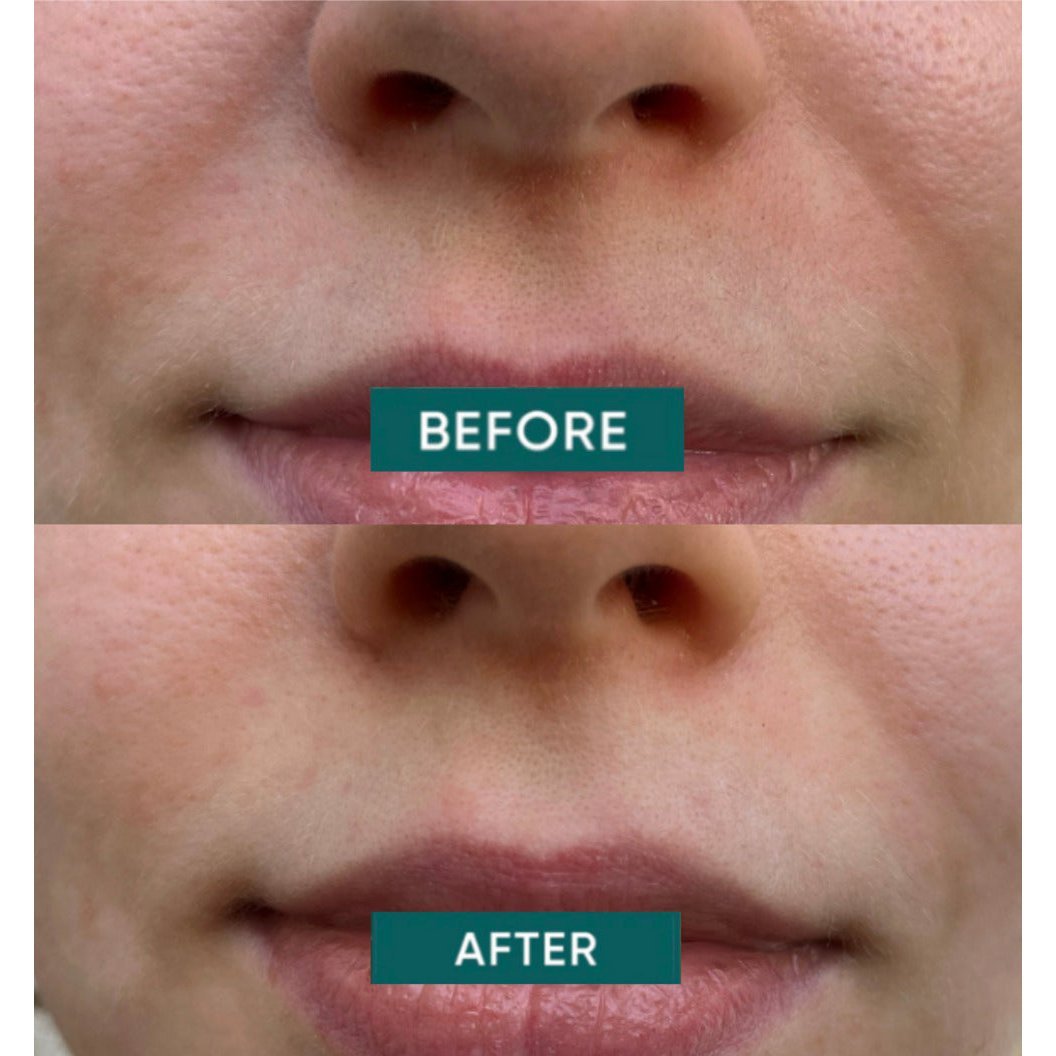 APRICOT pamučni flasteri za područje oko usana s hijaluronskom kiselinom - Slika 3